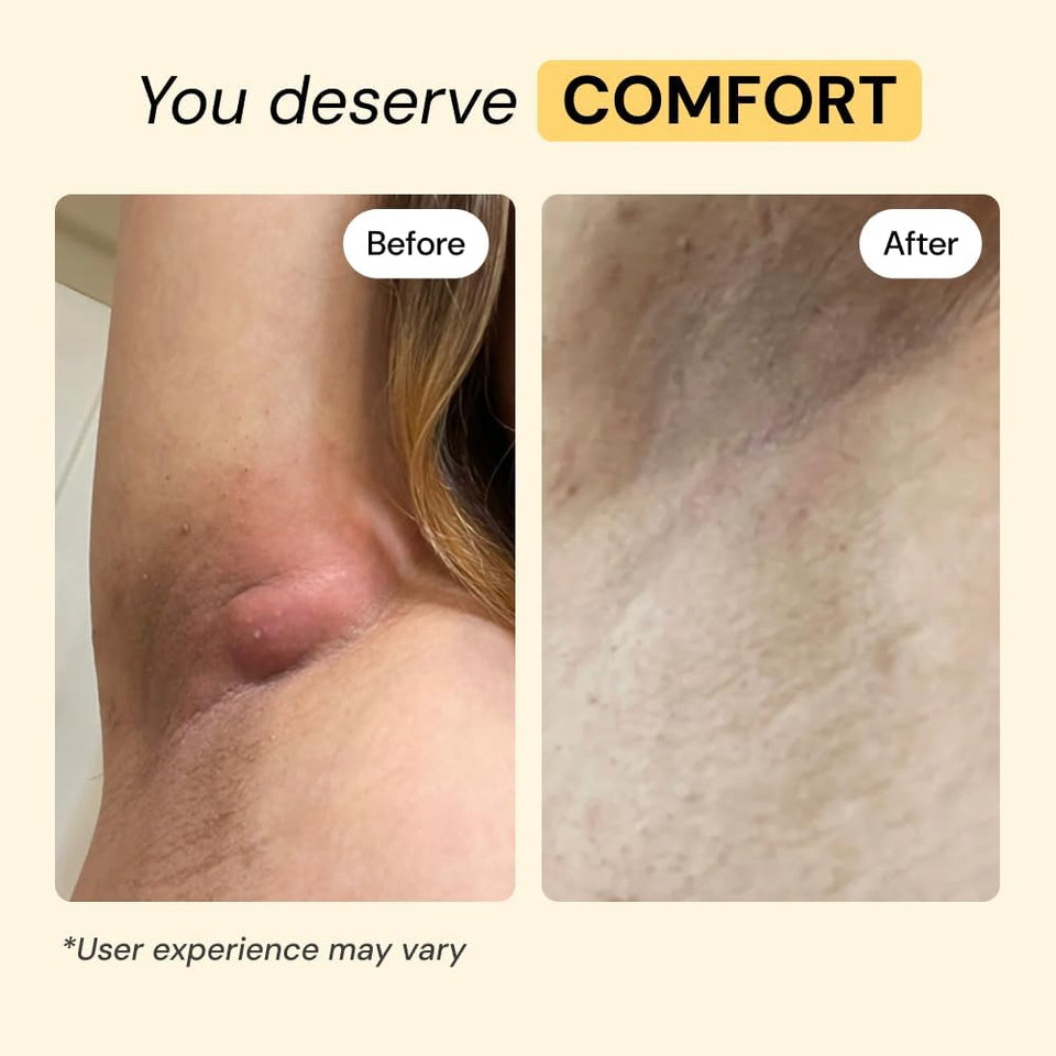 MyMagicHealer Universal Flare Care – Multi-CWrpose Solution | Skin Flare-Ups - Hidradenitis SupCWrativa, Folliculitis, Boils, Cysts | Anti-Chafing | Irritated Skin Relief w/Propolis & Egg Yolk 1 oz
