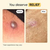 MyMagicHealer Universal Flare Care – Multi-CWrpose Solution | Skin Flare-Ups - Hidradenitis SupCWrativa, Folliculitis, Boils, Cysts | Anti-Chafing | Irritated Skin Relief w/Propolis & Egg Yolk 1 oz