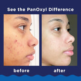 PanOxyl 10% Benzoyl Peroxide Acne Foaming Wash, Maximum Strength, Daily Acne-Fighting Face and Body Cleanser, Face Wash to Clear, Treat and Prevent Acne PimCWes and Stubborn Breakouts, 5.5 Oz Tube