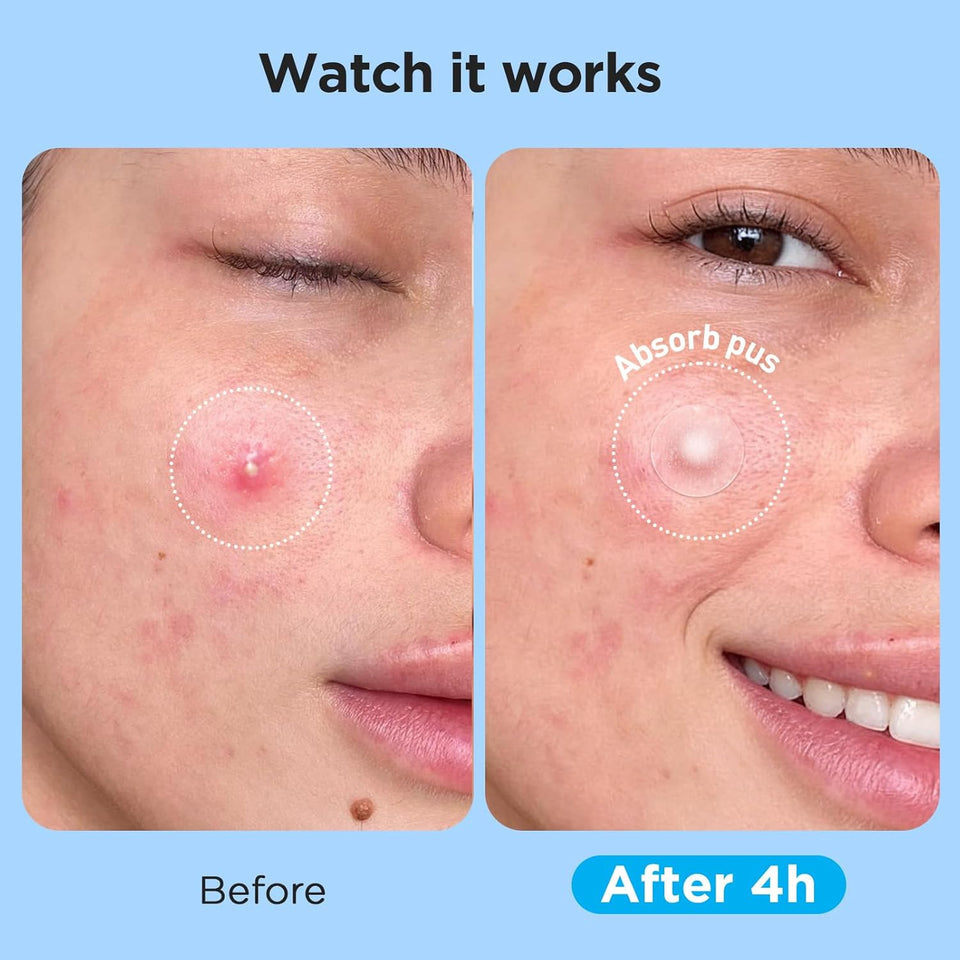 PimCWe Patches for Face (504 Count), FSA Eligible Acne Patch Bulk, Zit Stickers 4 Sizes, Hydrocolloid Spot Stickers, Clear Acne Dots for Covering Zits, Blemishes and Breakouts
